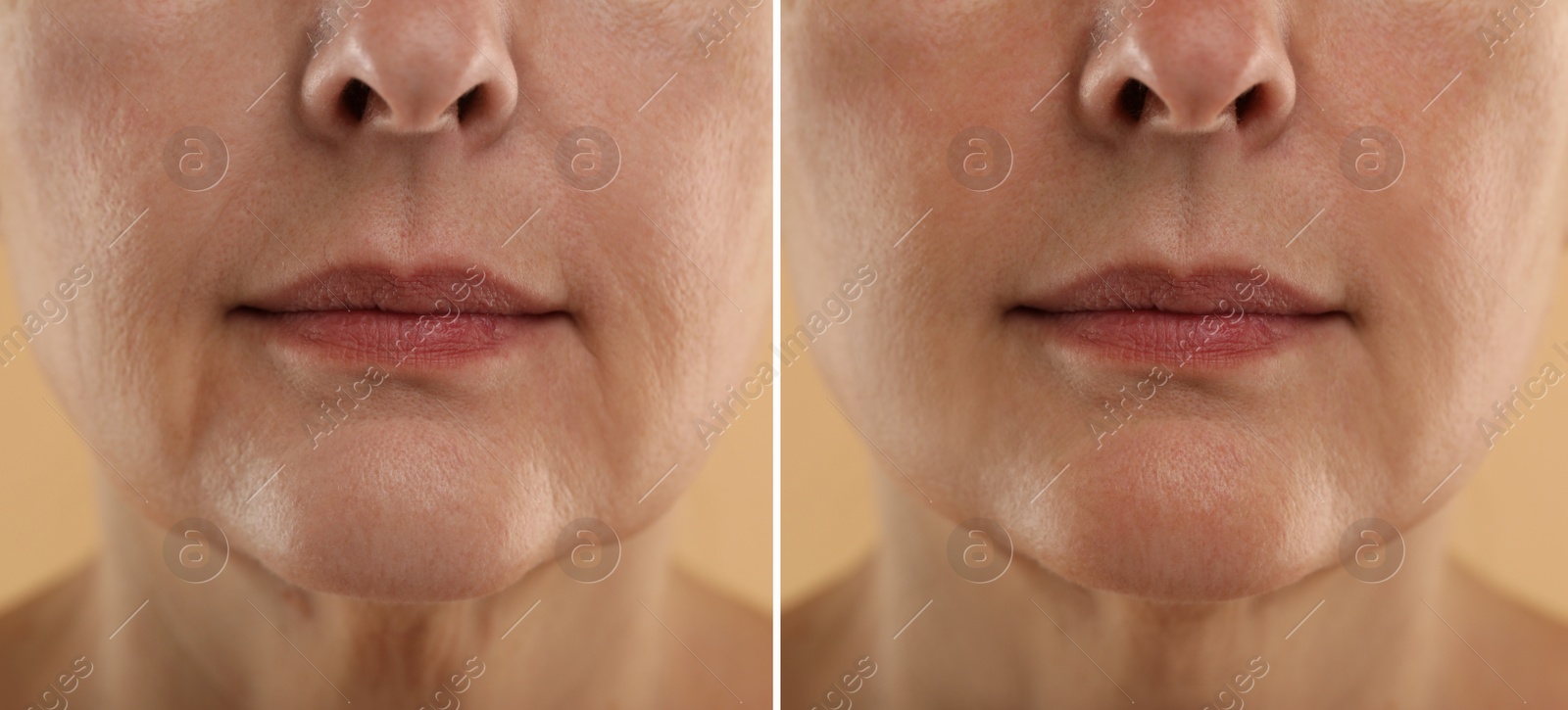 Image of Aging skin changes. Woman showing face before and after rejuvenation, closeup. Collage comparing skin condition