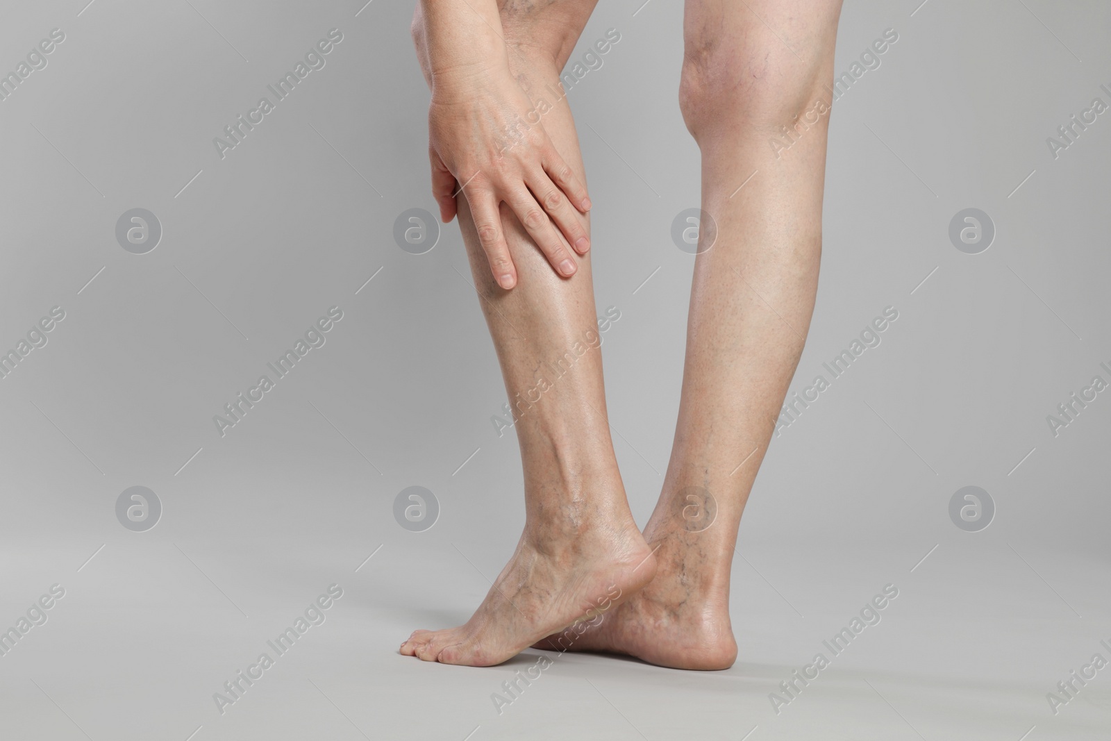 Photo of Closeup view of woman with varicose veins on light grey background