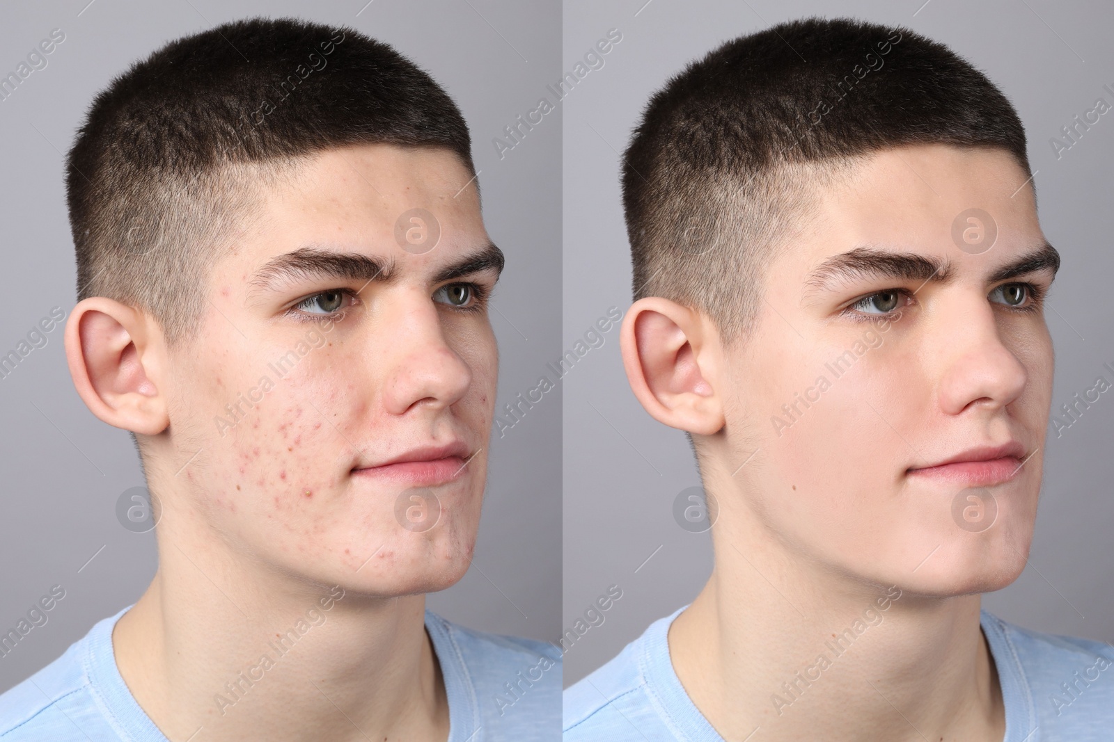 Image of Acne problem. Young man before and after treatment on grey background, collage of photos