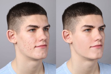 Image of Acne problem. Young man before and after treatment on grey background, collage of photos