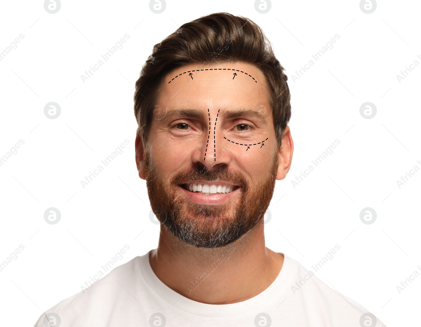 Image of Man with markings for cosmetic surgery on his face against white background