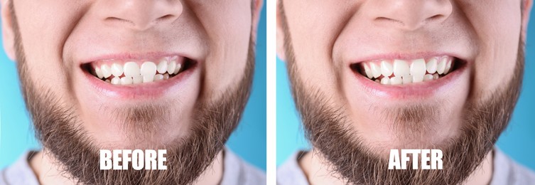 Image of Young man before and after gingivoplasty procedure on light blue background, closeup. Banner design