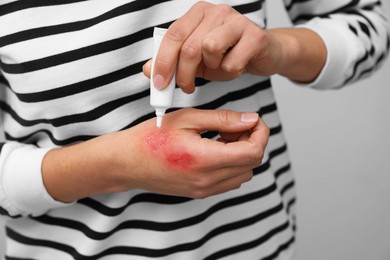 Photo of Woman applying healing cream onto burned hand on light grey background, closeup