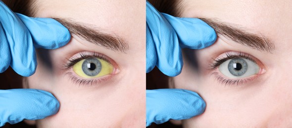 Collage with photos of woman before and after hepatitis treatment. Doctor checking patient on white background, closeup. Banner design