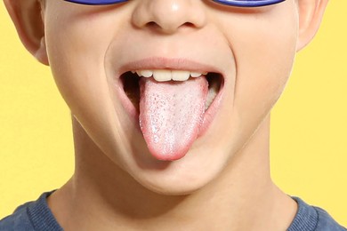 Image of Boy showing tongue with white patches on yellow background, closeup. Oral candidiasis (thrush) disease