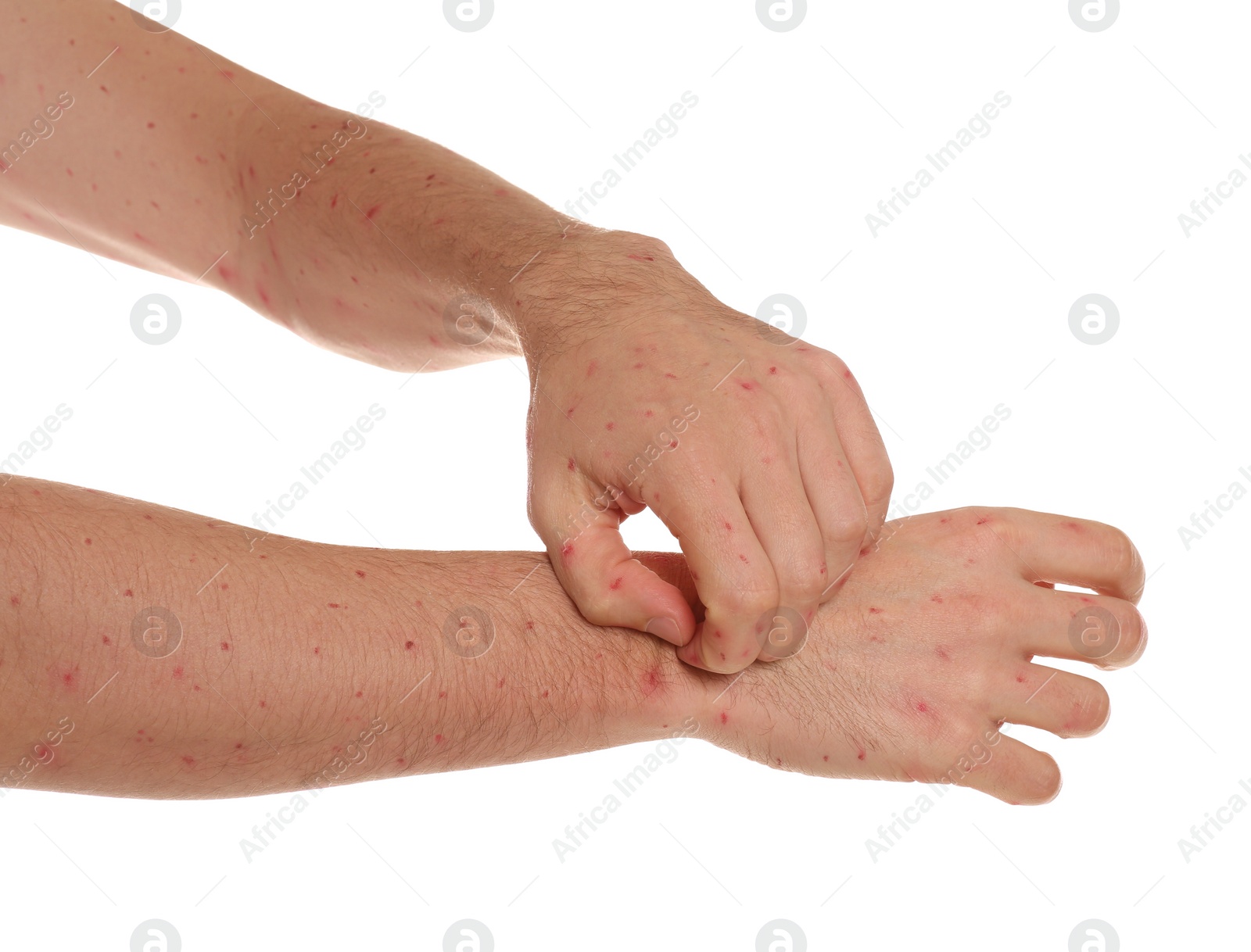 Photo of Man with rash suffering from monkeypox virus on white background, closeup