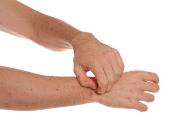 Photo of Man with rash suffering from monkeypox virus on white background, closeup