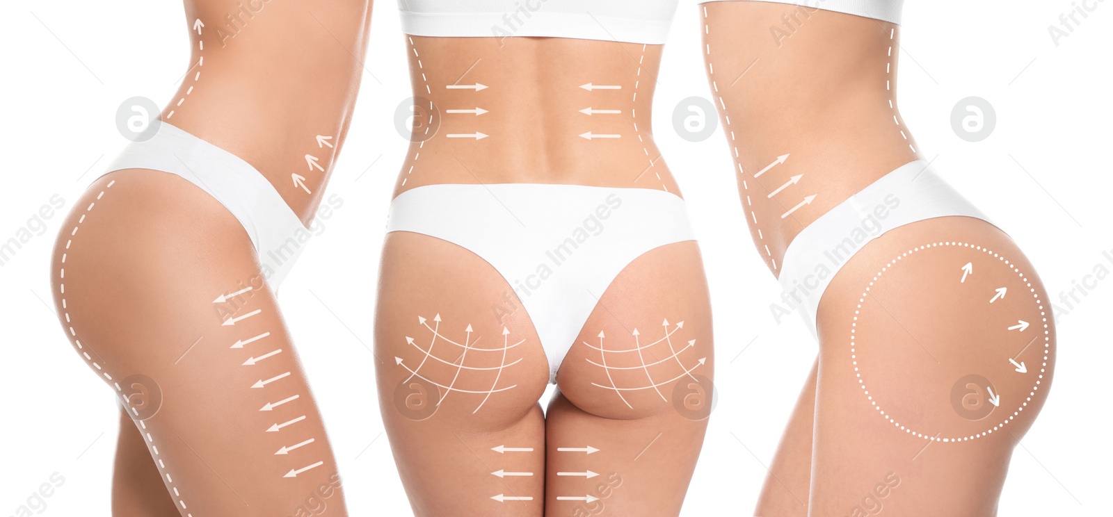 Image of Photos of young woman with marks on body against white background, collage. Cosmetic surgery concept