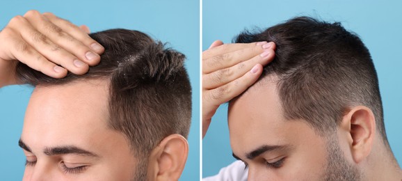 Man showing hair before and after dandruff treatment on light blue background, collage