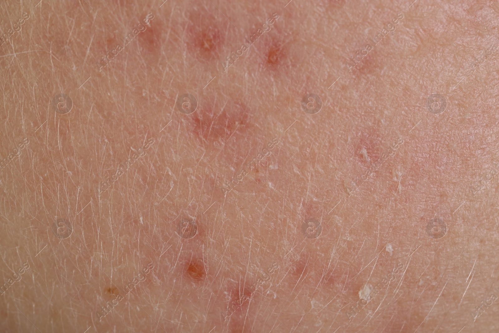 Photo of Texture of skin with acne problem as background, macro view