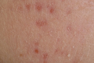 Texture of skin with acne problem as background, macro view
