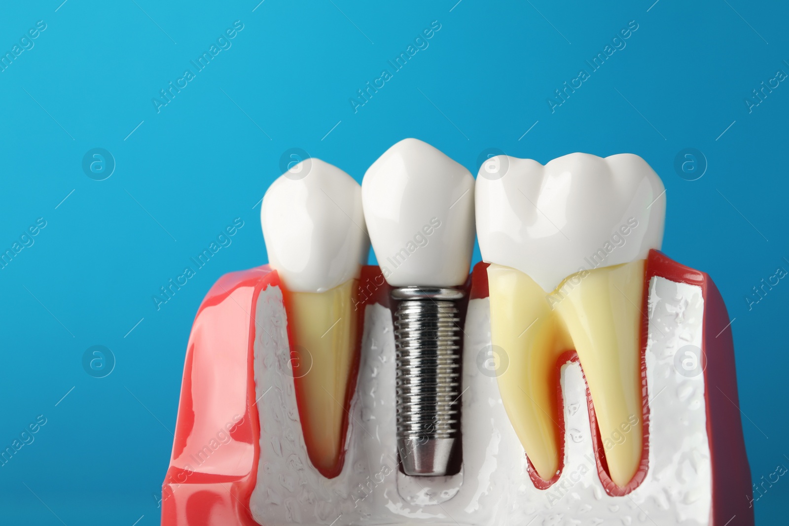 Photo of Educational model of gum with dental implant between teeth on light blue background, closeup
