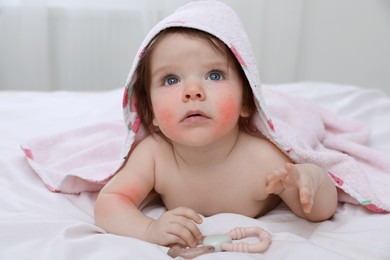 Image of Cute little baby with allergic redness in hooded towel after bathing on bed at home