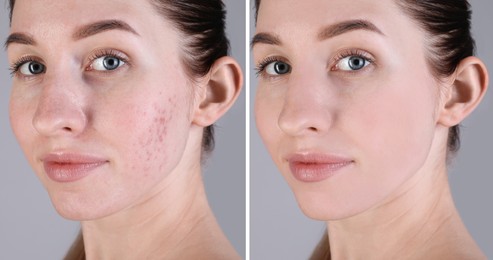 Acne problem. Young woman before and after treatment on grey background, collage of photos