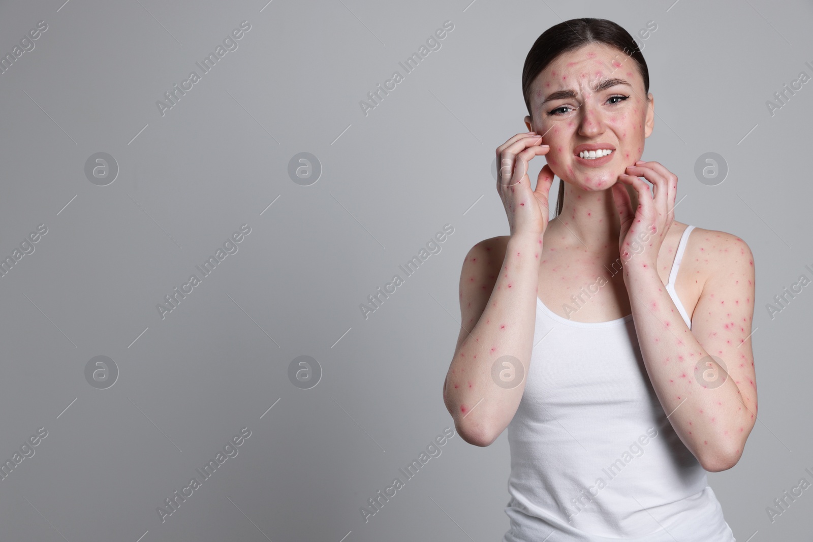 Photo of Woman with rash suffering from monkeypox virus on light grey background. Space for text