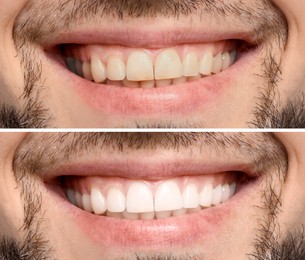 Image of Collage with photos of man before and after teeth whitening, closeup