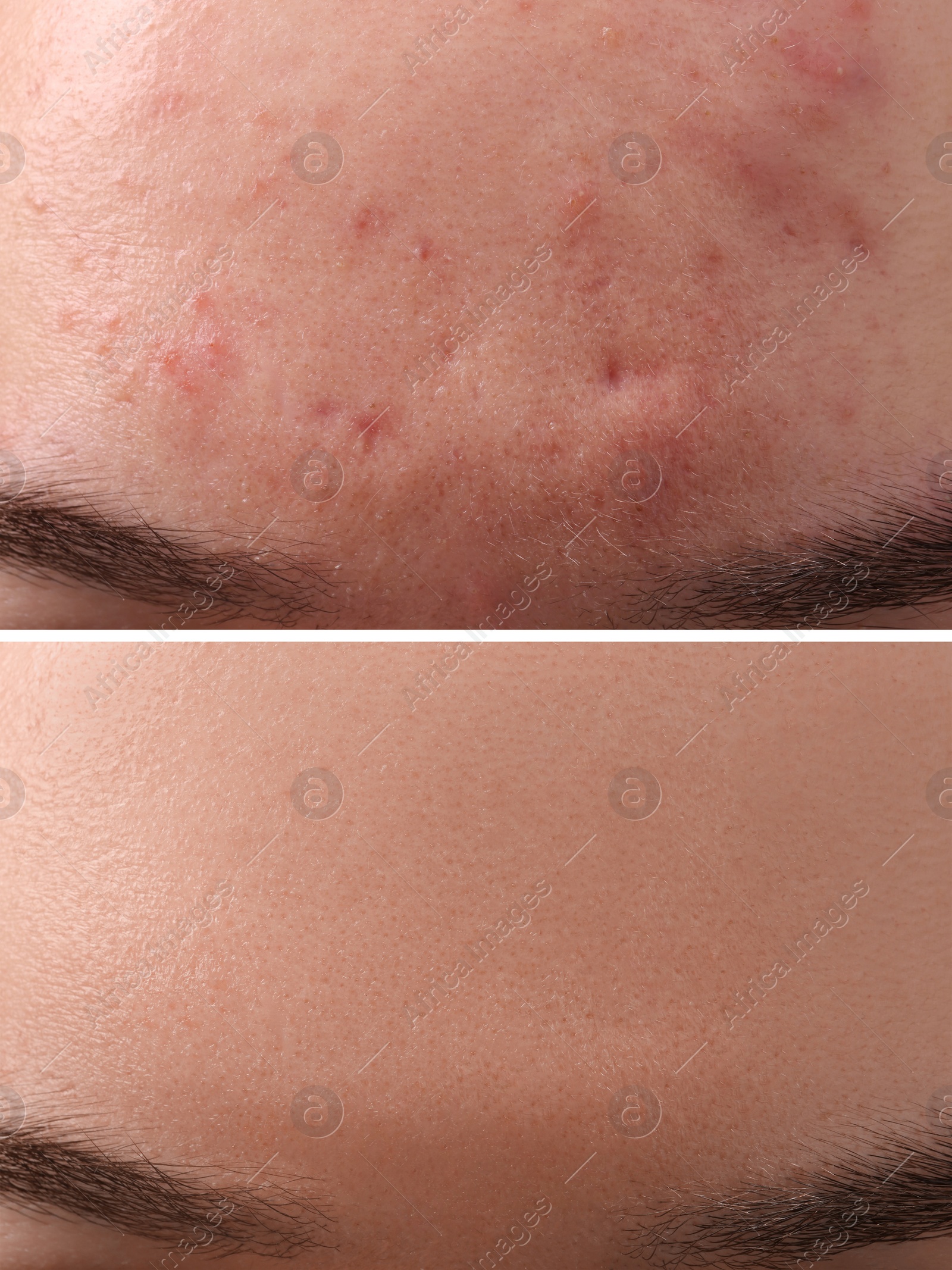 Image of Collage with photos of woman with acne problem before and after treatment, closeup