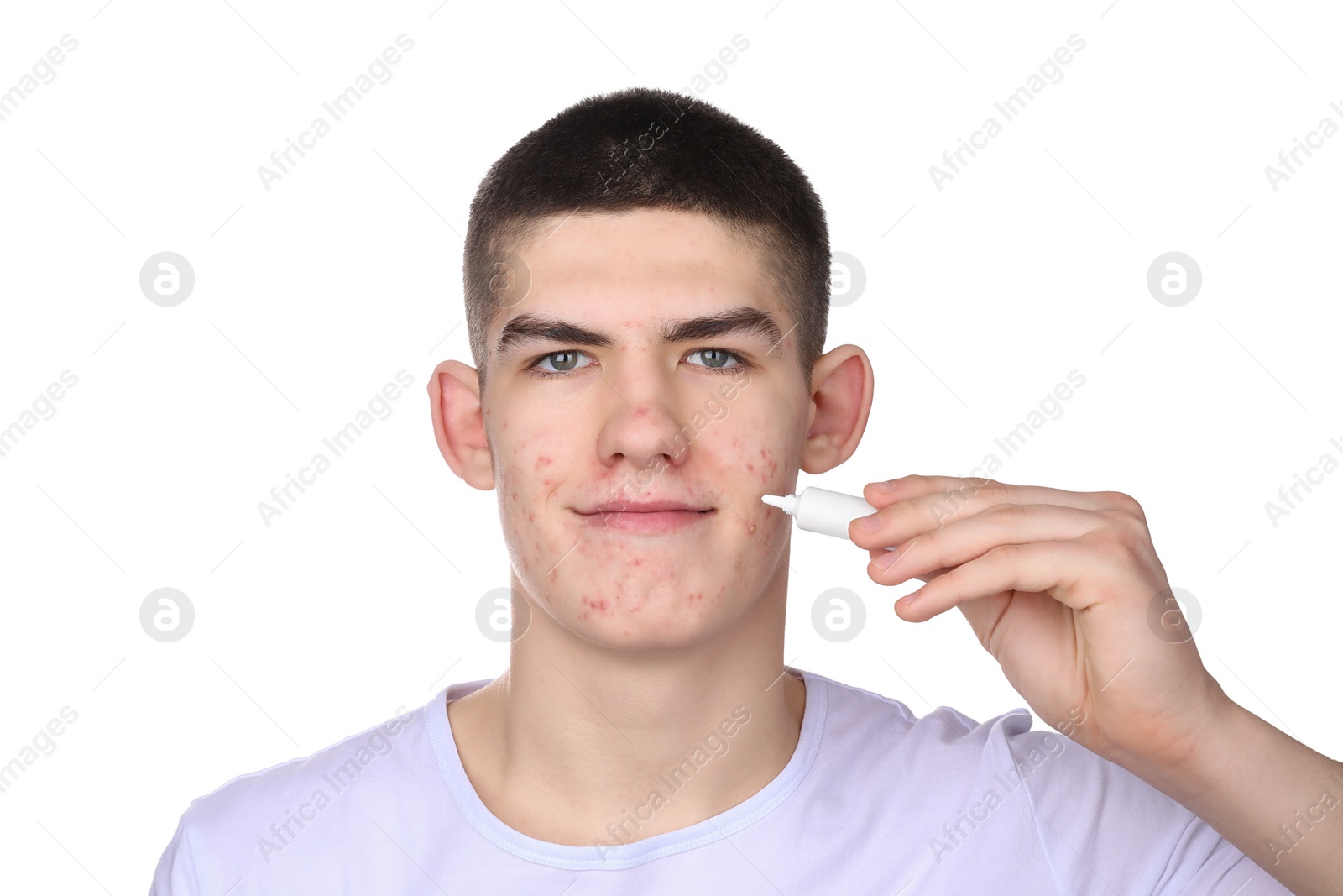 Photo of Young man with acne problem applying cosmetic product onto his skin on white background