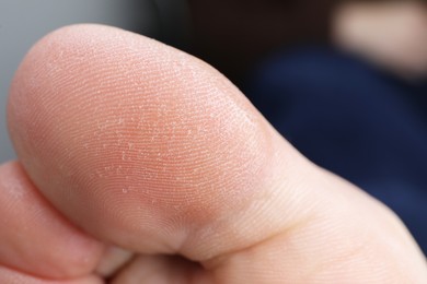 Woman with dry skin on toes against blurred background, closeup