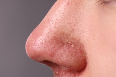 Photo of Young man with acne problem on grey background, closeup view of nose