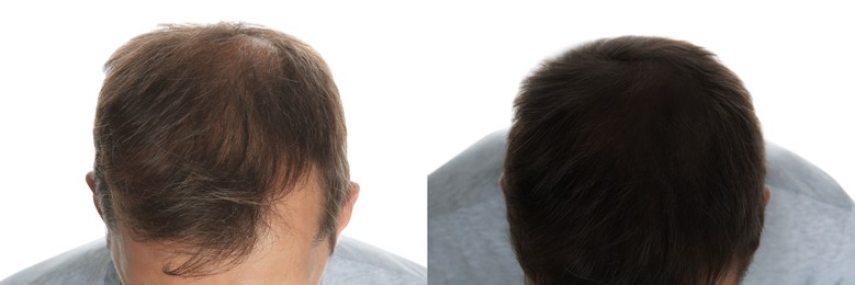 Image of Man before and after hair treatment with high frequency darsonval device on white background, closeup. Collage of photos