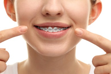 Photo of Smiling woman pointing at her dental braces on white background, closeup
