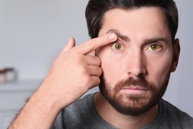 Photo of Man with yellow eyes on blurred background. Symptom of hepatitis