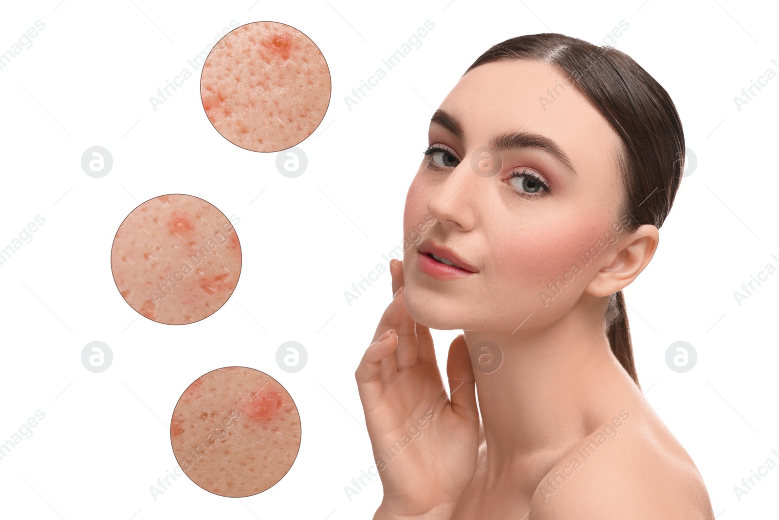 Image of Dermatology. Woman with skin problem on white background. Zoomed areas showing acne