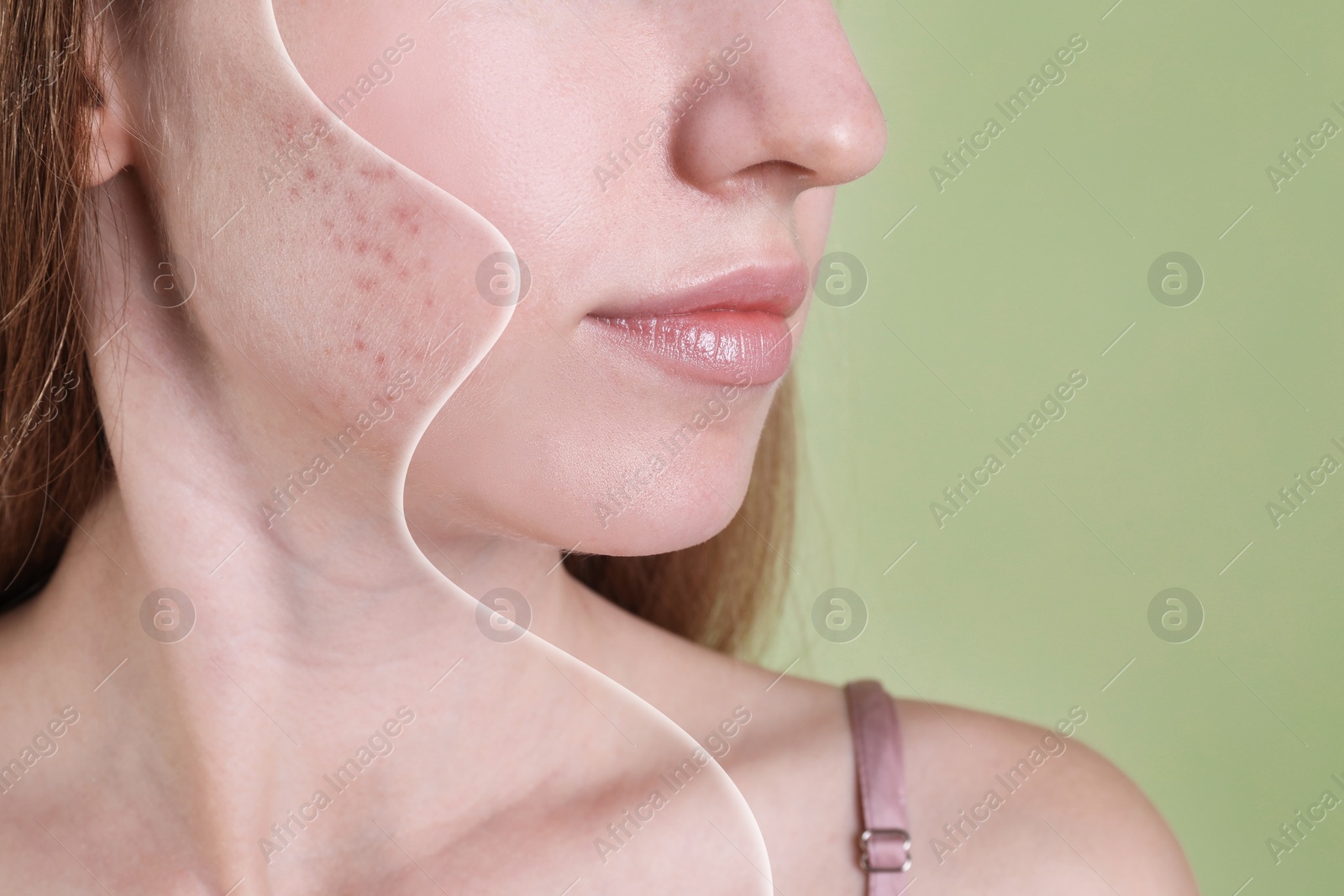 Image of Acne problem, collage. Woman before and after treatment on green background, closeup