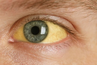 Photo of Man with yellow eyes, closeup view. Symptom of hepatitis