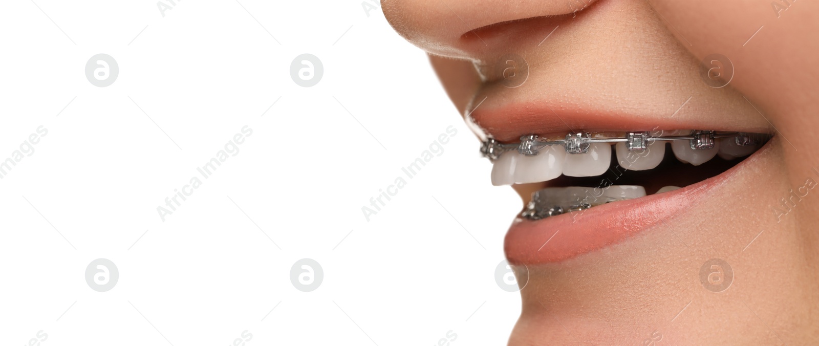 Image of Smiling woman with braces on white background, closeup. Banner design with space for text