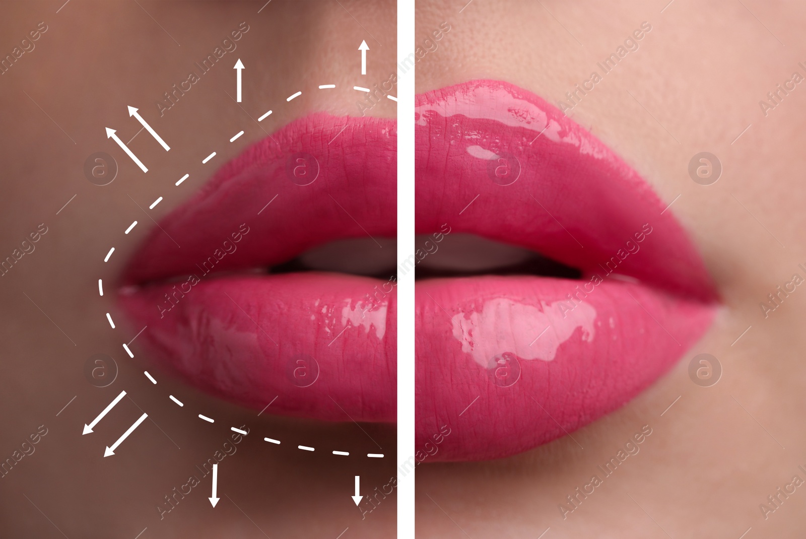 Image of Collage with photos of young woman before and after lips augmentation procedure, closeup