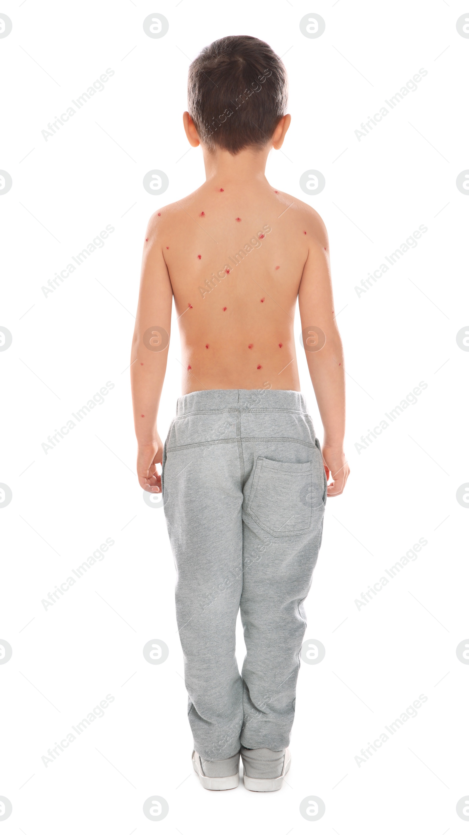 Photo of Little boy with chickenpox on white background