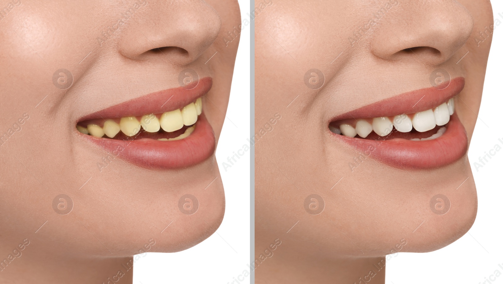 Image of Collage with photos of woman before and after tooth whitening on white background, closeup