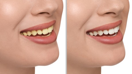 Collage with photos of woman before and after tooth whitening on white background, closeup