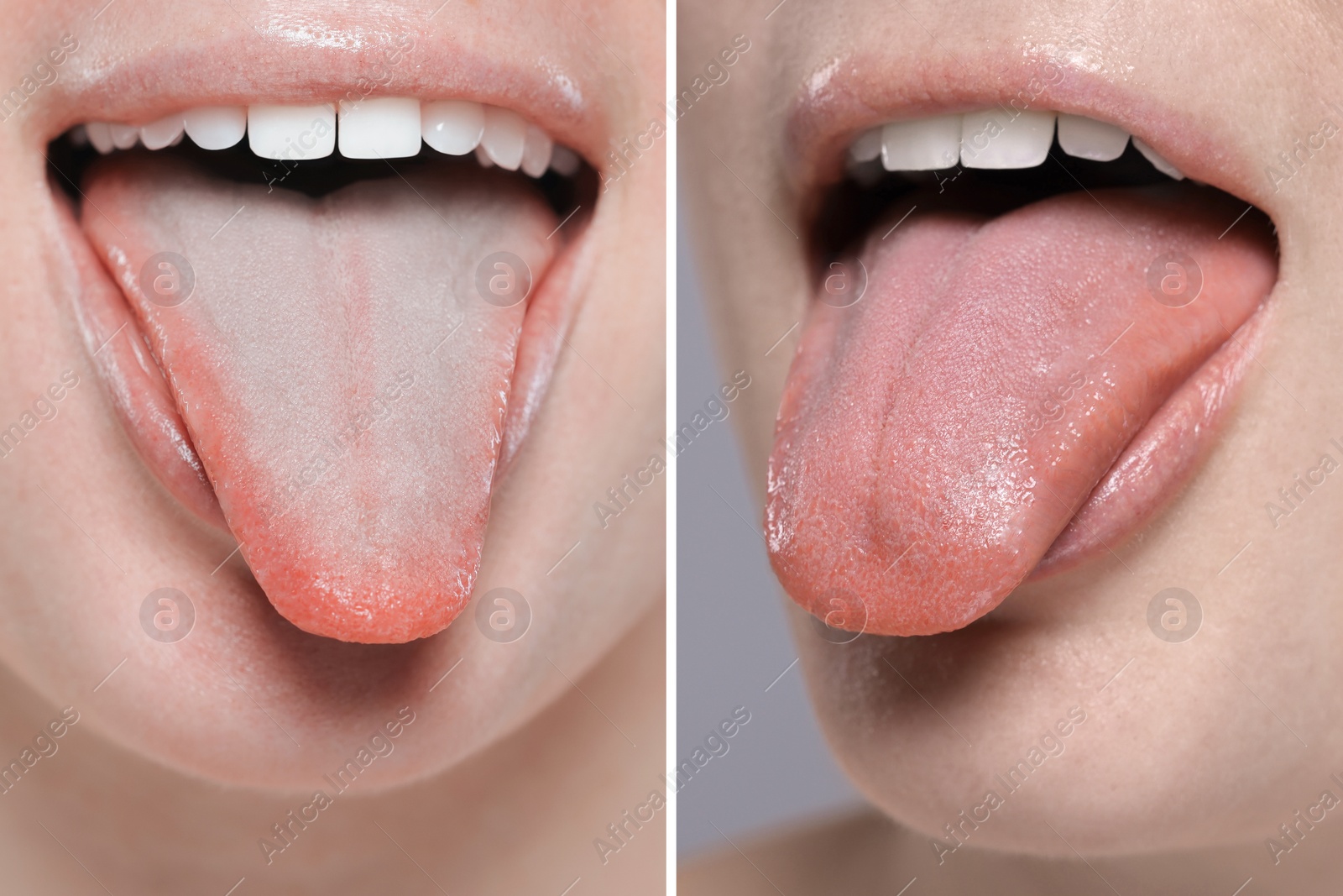 Image of Woman showing her tongue before and after cleaning procedure, closeup. Tongue coated with plaque on one side and healthy on other, collage