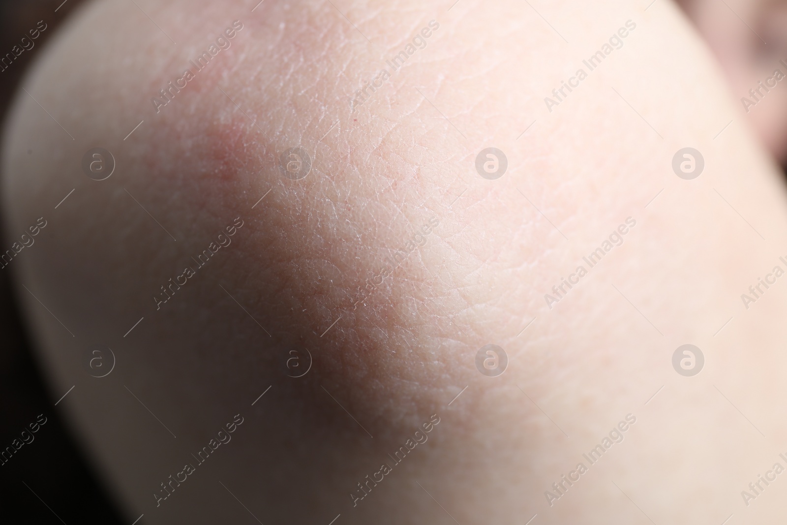 Photo of Woman with dry skin on elbow, closeup