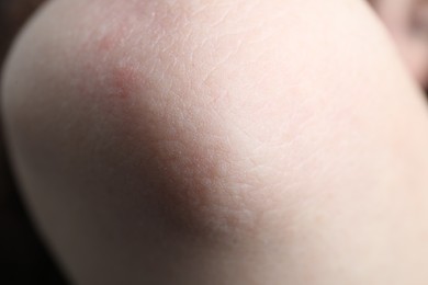 Woman with dry skin on elbow, closeup