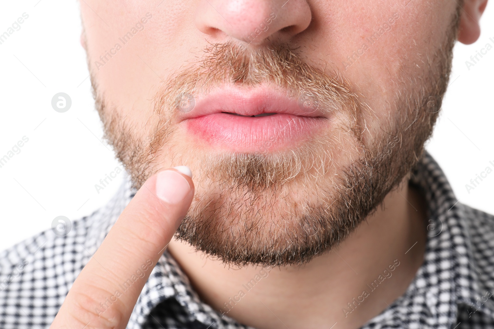 Photo of Young man applying cold sore cream on lips against white background, closeup