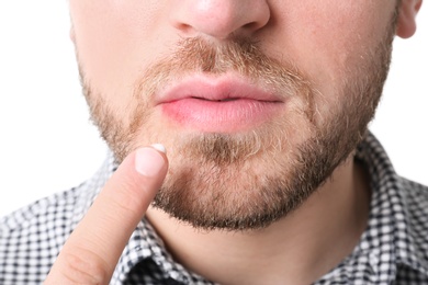 Young man applying cold sore cream on lips against white background, closeup