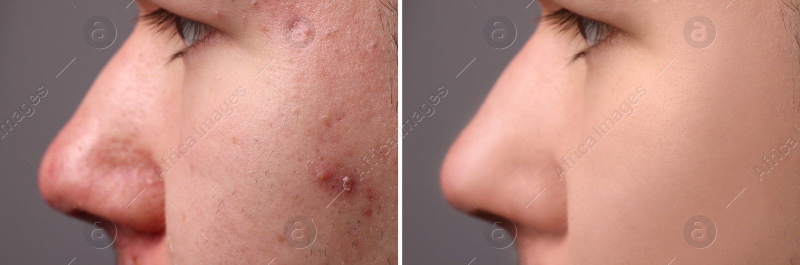 Image of Before and after acne treatment. Photos of man on grey background, closeup. Collage showing affected and healthy skin