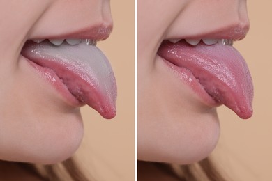 Image of Woman showing her tongue before and after cleaning procedure, closeup. Tongue coated with plaque on one side and healthy on other, collage