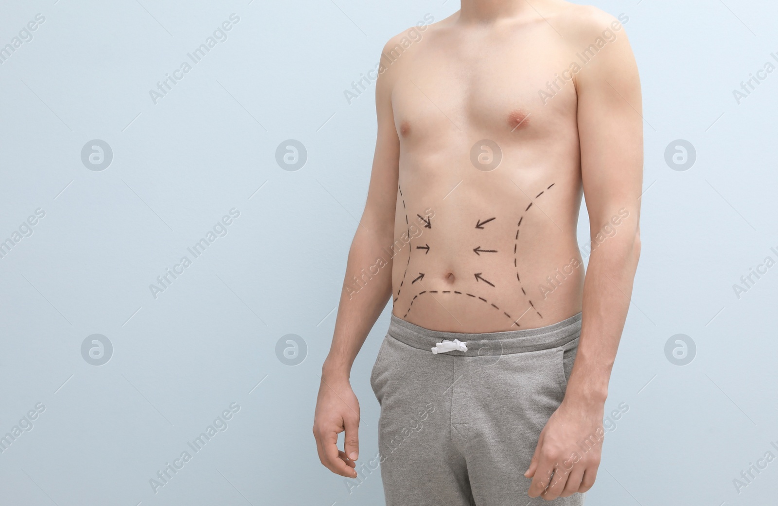 Photo of Young man with marks on belly for cosmetic surgery operation on light background