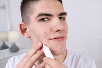 Young man with acne problem applying cosmetic product onto his skin indoors