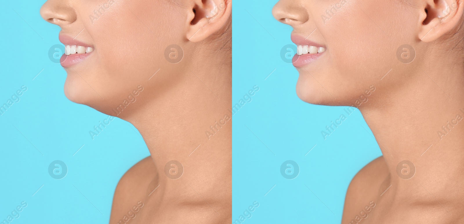 Image of Double chin problem. Collage with photos of young woman before and after plastic surgery procedure on turquoise background, closeup
