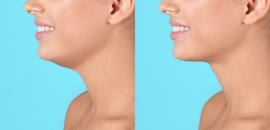 Image of Double chin problem. Collage with photos of young woman before and after plastic surgery procedure on turquoise background, closeup
