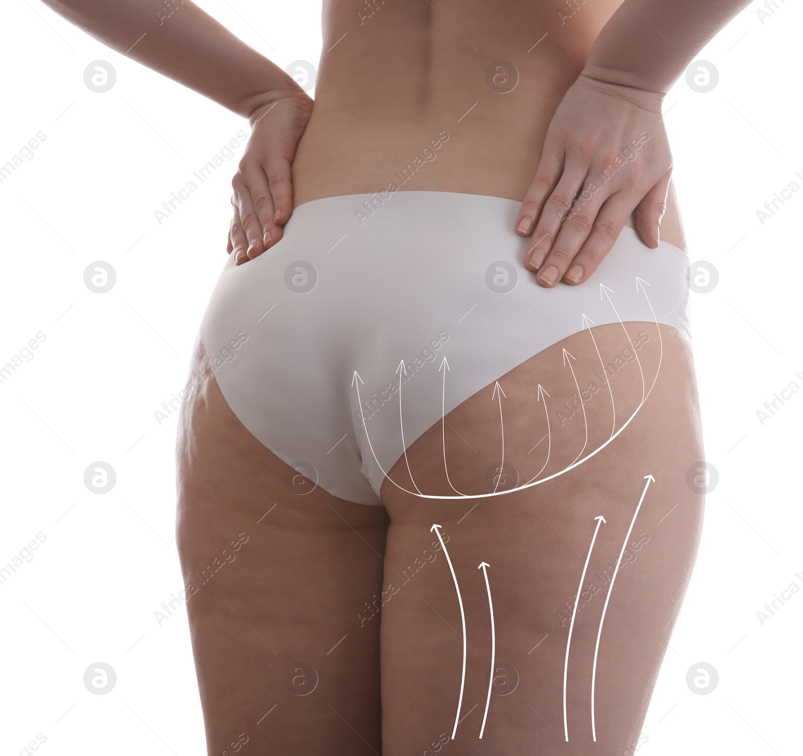 Image of Woman with marks on body before cosmetic surgery operation on white background, closeup