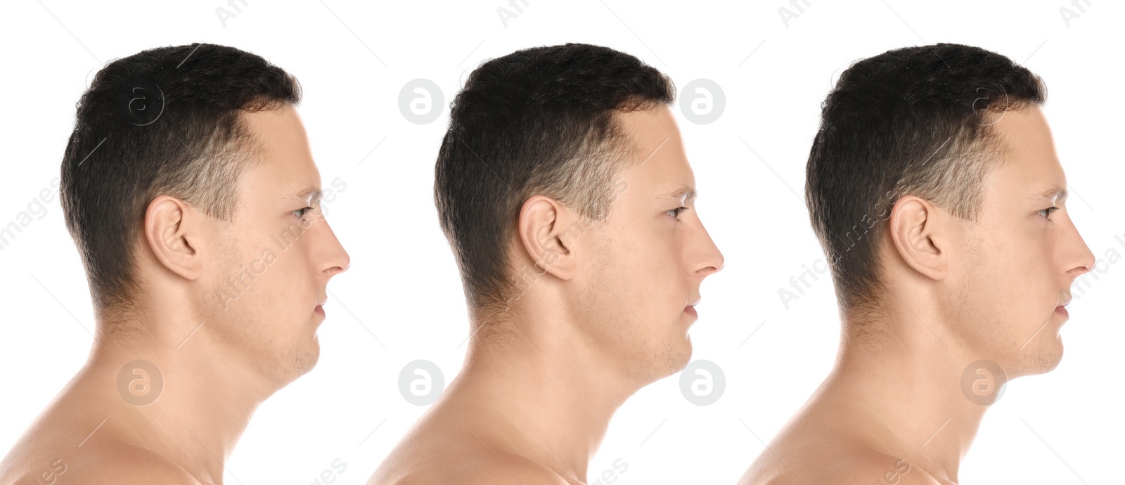 Image of Double chin problem. Collage with photos of man before and after plastic surgery procedure on white background, banner design