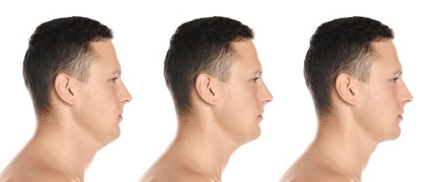 Image of Double chin problem. Collage with photos of man before and after plastic surgery procedure on white background, banner design