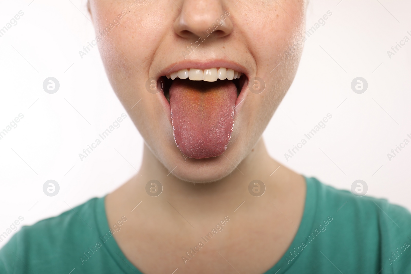 Photo of Gastrointestinal diseases. Woman showing her yellow tongue on white background, closeup